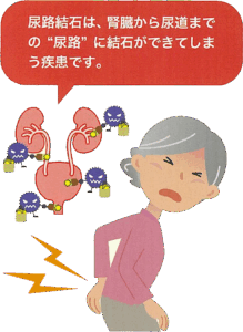 尿路結石は、腎臓から尿道までの“尿路”に結石ができてしまう疾患です。